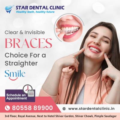 Braces Specialist in Pimple Saudagar | Star Dental Clinic - Pune Health, Personal Trainer