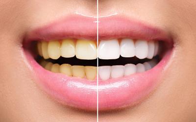 Teeth Whitening Cost in India - Bangalore Health, Personal Trainer