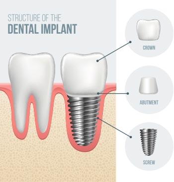 Affordable Implant Dentures in Woodland Hills 