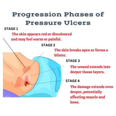 Progression phases of pressure ulcers | Synerheal Pharmaceuticals - Chennai Health, Personal Trainer