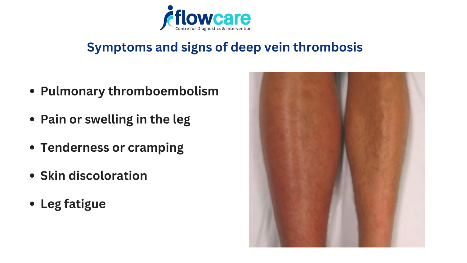 Recognizing Deep Vein Thrombosis Symptoms: A Guide by FlowCare