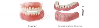 The Pros And Cons Of Snap On Dentures | Dentist of Woodland Hills 