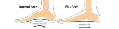 Achilles Tendonitis Flat Feet | Boynerclinic.com