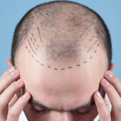 Hair Transplant Treatment in Pune  - Other Health, Personal Trainer