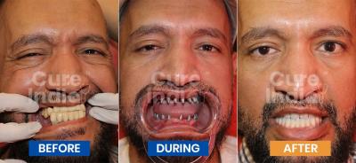 A Smile Reborn: Dental Implants Before and After - Adelaide Health, Personal Trainer