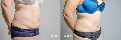 Tummy Tuck Surgery Clinic in Ahmedabad - Ahmedabad Health, Personal Trainer