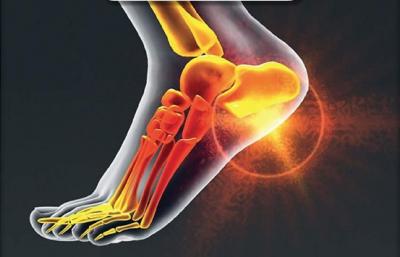 Calcaneal Spur | Boynerclinic.com