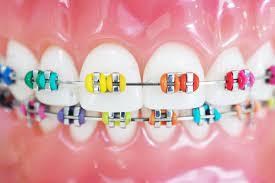 Braces Dentist in Manalapan, NJ - Other Other