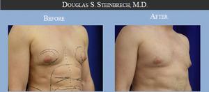 Confidence Restored - Male Breast Reduction in Los Angeles - Los Angeles Health, Personal Trainer