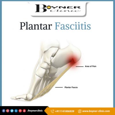 Best Insoles For Plantar Fasciitis | Boynerclinic.com