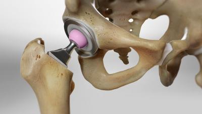 Get To Know About Hip Replacement Surgery Cost