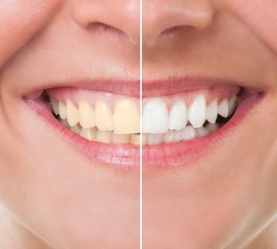 Teeth whitening and Bleaching-laser teeth whitening Bangalore - Bangalore Health, Personal Trainer