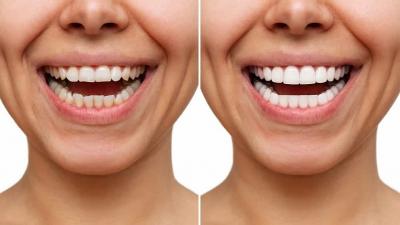 Teeth Whitening in Caulfield – BEDC