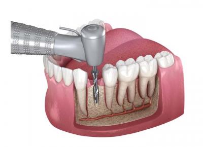 Dental Aesthetics & Root Canal Treatment in Gurgaon India - Gurgaon Other