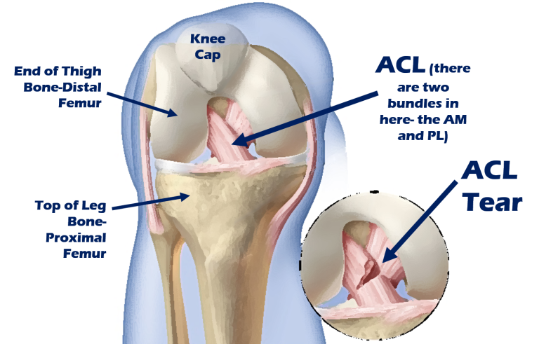 Premier ACL Reconstruction Surgery by India's Elite Orthopedic Surgeons - Ahmedabad Health, Personal Trainer