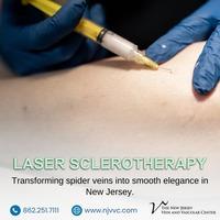 Laser Sclerotherapy in NJ - Other Health, Personal Trainer