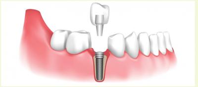 Dental Implants In Abu Dhabi | Best Dental Implants Clinic