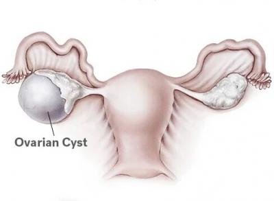 How long does recovery take after fibroid surgery?