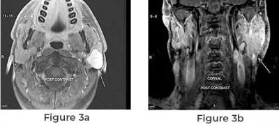 Parotid Tumor Surgery - Other Health, Personal Trainer