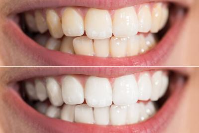 Zoom Whitening in Caulfield – BEDC - Melbourne Other