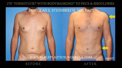 Reclaim Your Confidence: Tummy Tuck for Men Los Angeles.