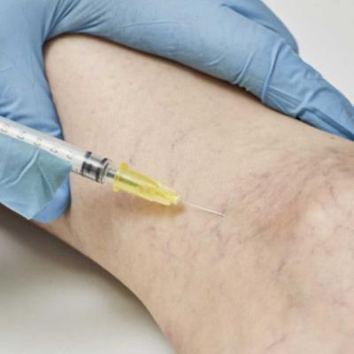 Varicose Veins Treatment at Estheticlavc - New York Other