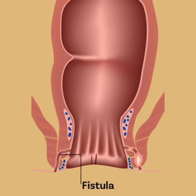 Effective Fistula Treatment Solutions in India! - Delhi Health, Personal Trainer