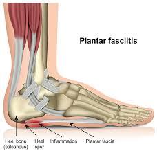 Soothing Steps: Footworks Podiatry's Approach to Plantar Fasciitis Heel Pain