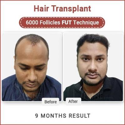 Unshaven Hair Transplant In India