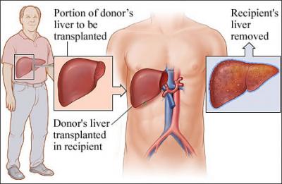 liver transplant treatment in India