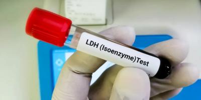 LDH Isoenzymes Testing by Electrophoresis | Agilus Diagnostics