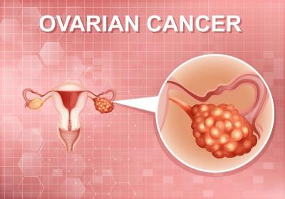 Top-rated Surgeons for Ovarian Cancer Surgery in Ahmedabad