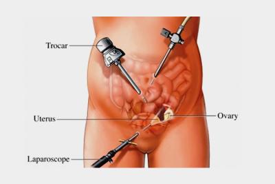 Reliable Hysterectomy Doctors in Ahmedabad