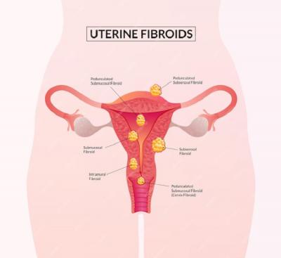 Best Doctors for Uterine Fibroids Treatment in Ahmedabad