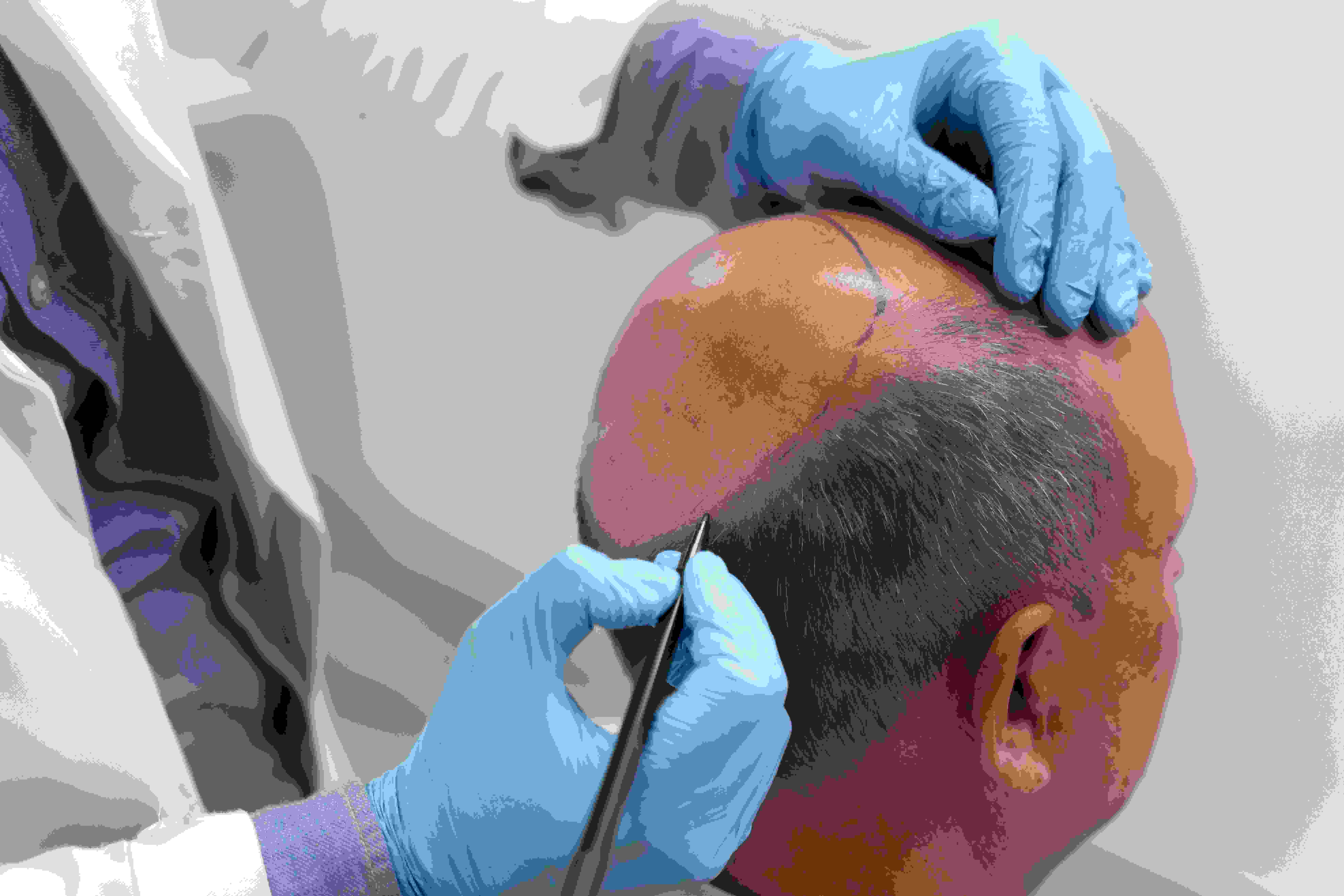 Best Hair Transplant Clinic in Kompally Hyderabad - Hyderabad Professional Services