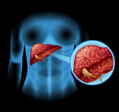 Liver Cancer Treatment in india