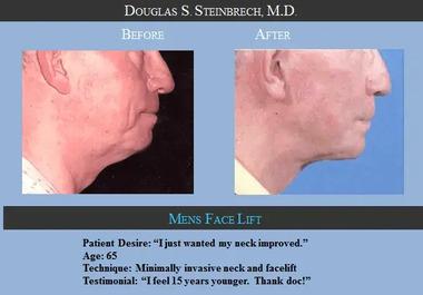 Redefine Your Youthful Charm with Male Facelift in Los Angeles