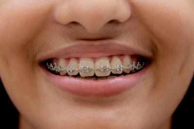 Transform Your Smile with Traditional Braces in Franklin, Canberra!