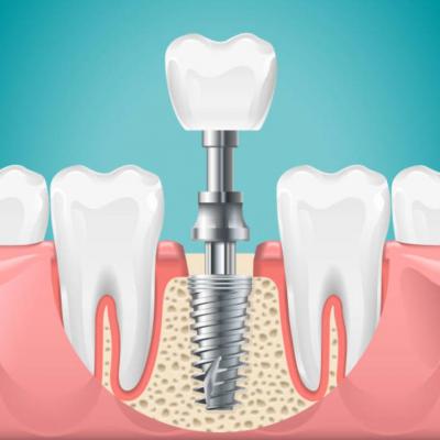 Looking for the best Dental Implants in Kolkata? Choose Mission Smile Dental Clinic!