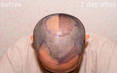 Achieve the Best Hair Transplant in the UK with Want Hair! - London Health, Personal Trainer