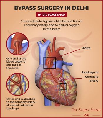 Best Bypass Surgeon In Delhi- Dr. Sujay Shad 