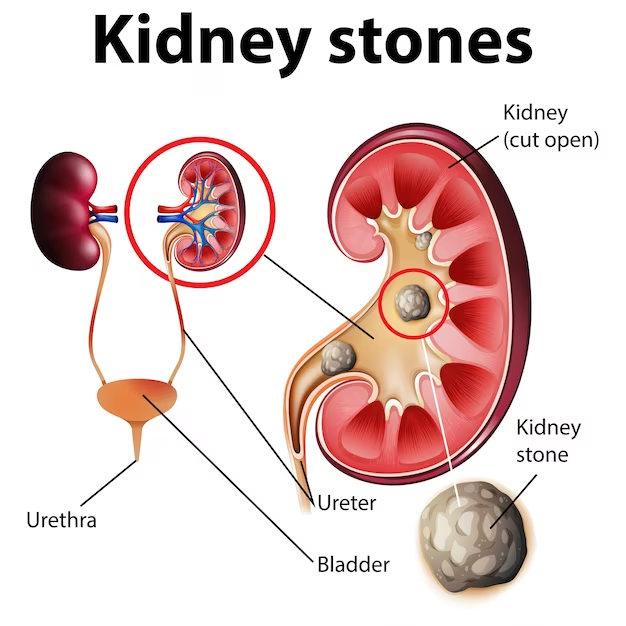 Seeking For the Best Hospital for Kidney Stone Surgery in Delhi? Visit Delhi Urology Hospital