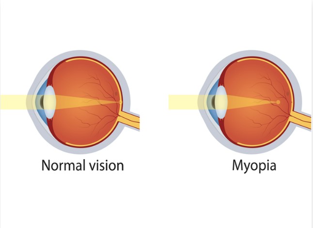 Myopia Eye Surgery