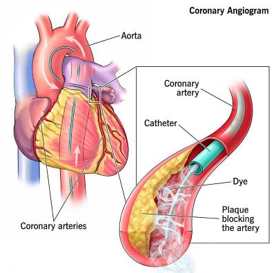 Coronary angiogram treatment cost in India