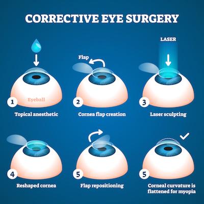 Best Hospital for Lasik Eye Surgery in Delhi