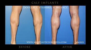 Calf Implants Los Angeles