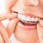 Invisalign Braces Cost in Bangalore - Amaya Dental Clinic - Bangalore Health, Personal Trainer