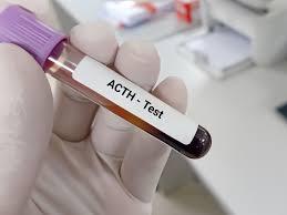 Adrenocorticotropic Hormone (ACTH) Test Pune