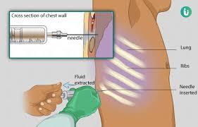 Adenosine Deaminase (ADA) Test Fluid Pune