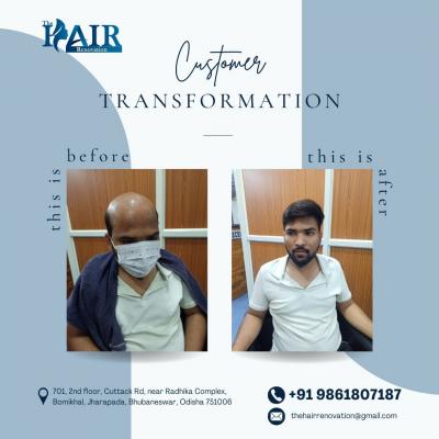 Boost Your Hair Volume: Non-Surgical Hair Replacement (Bhubaneswar) - Bhubaneswar Professional Services